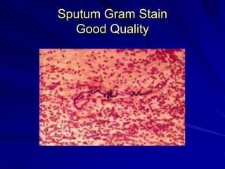 Sputum Gram Stain
Good Quality
 