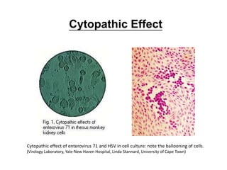 Cytopathic Effect
Cytopathic effect of enterovirus 71 and HSV in cell culture: note the ballooning of cells.
(Virology Laboratory, Yale-New Haven Hospital, Linda Stannard, University of Cape Town)
 