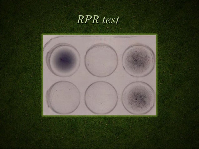 Lab diagnosis of syphilis