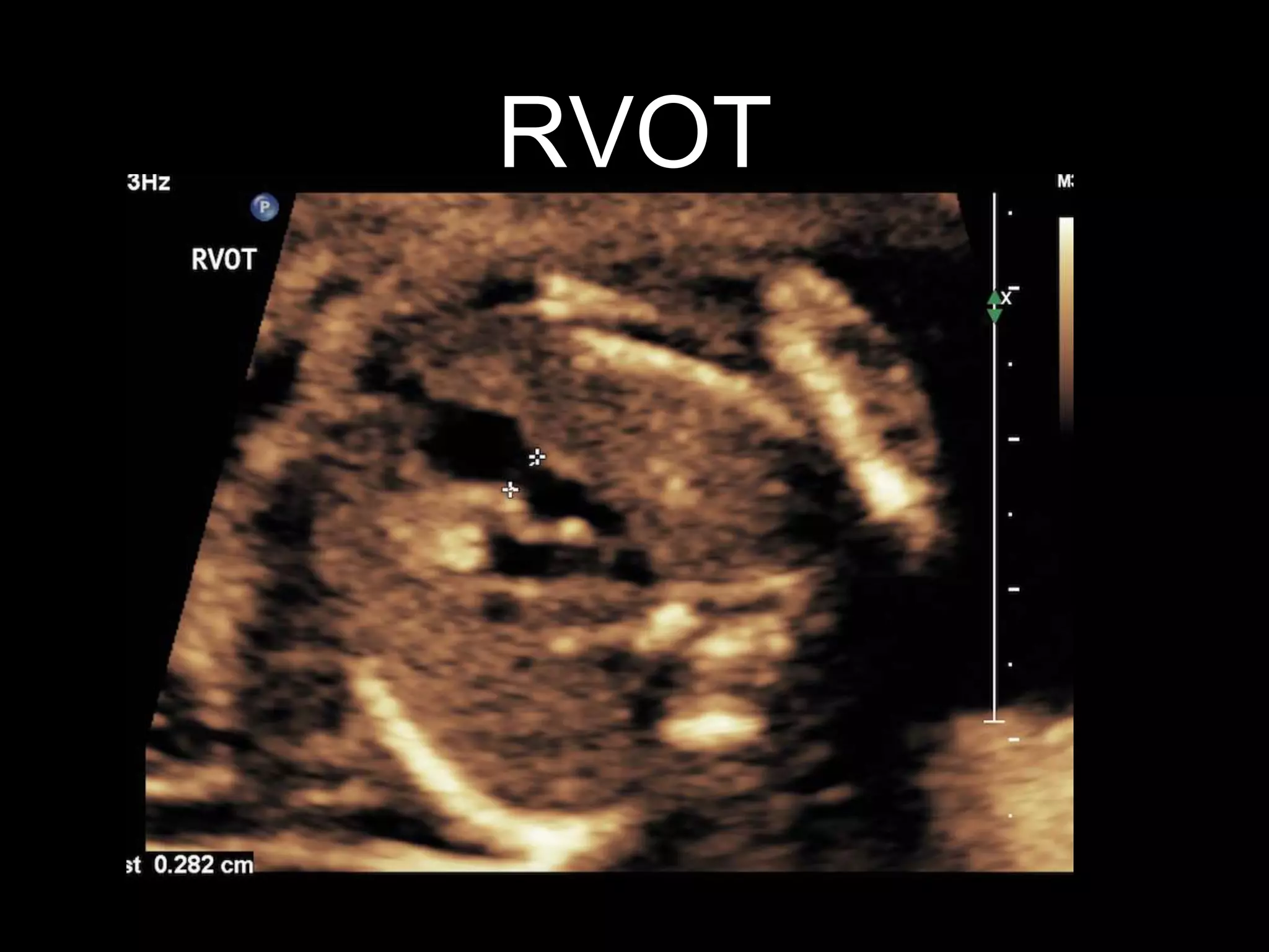 Labelled fetal heart ultrasound | PPTX