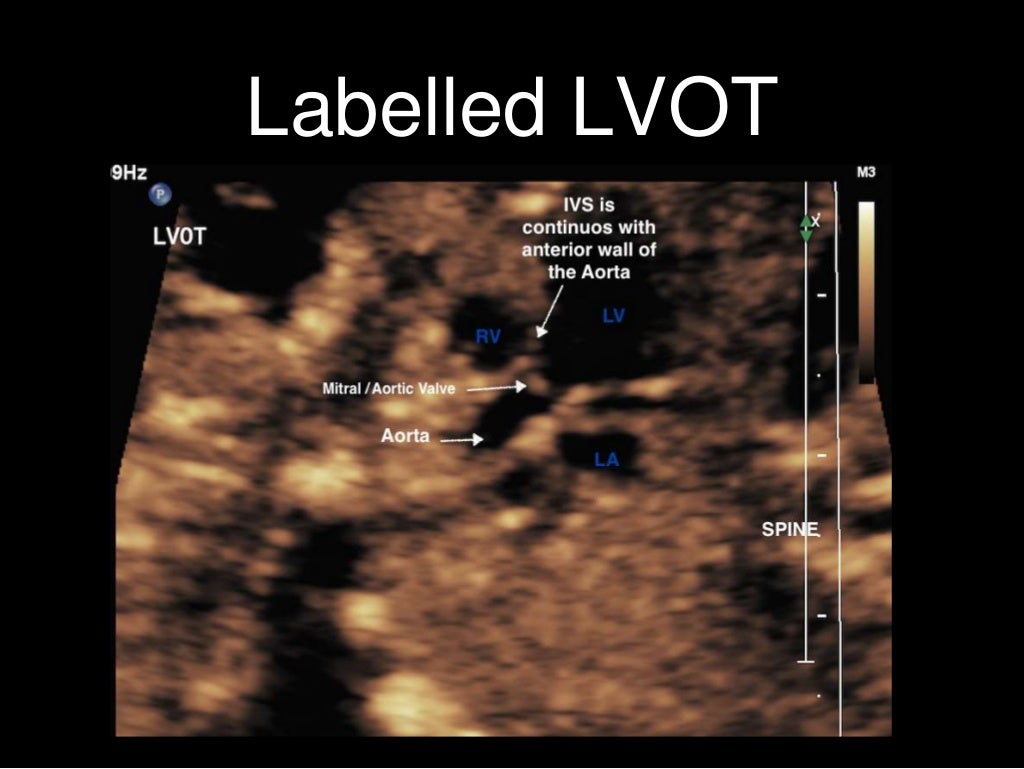 Labelled fetal heart ultrasound