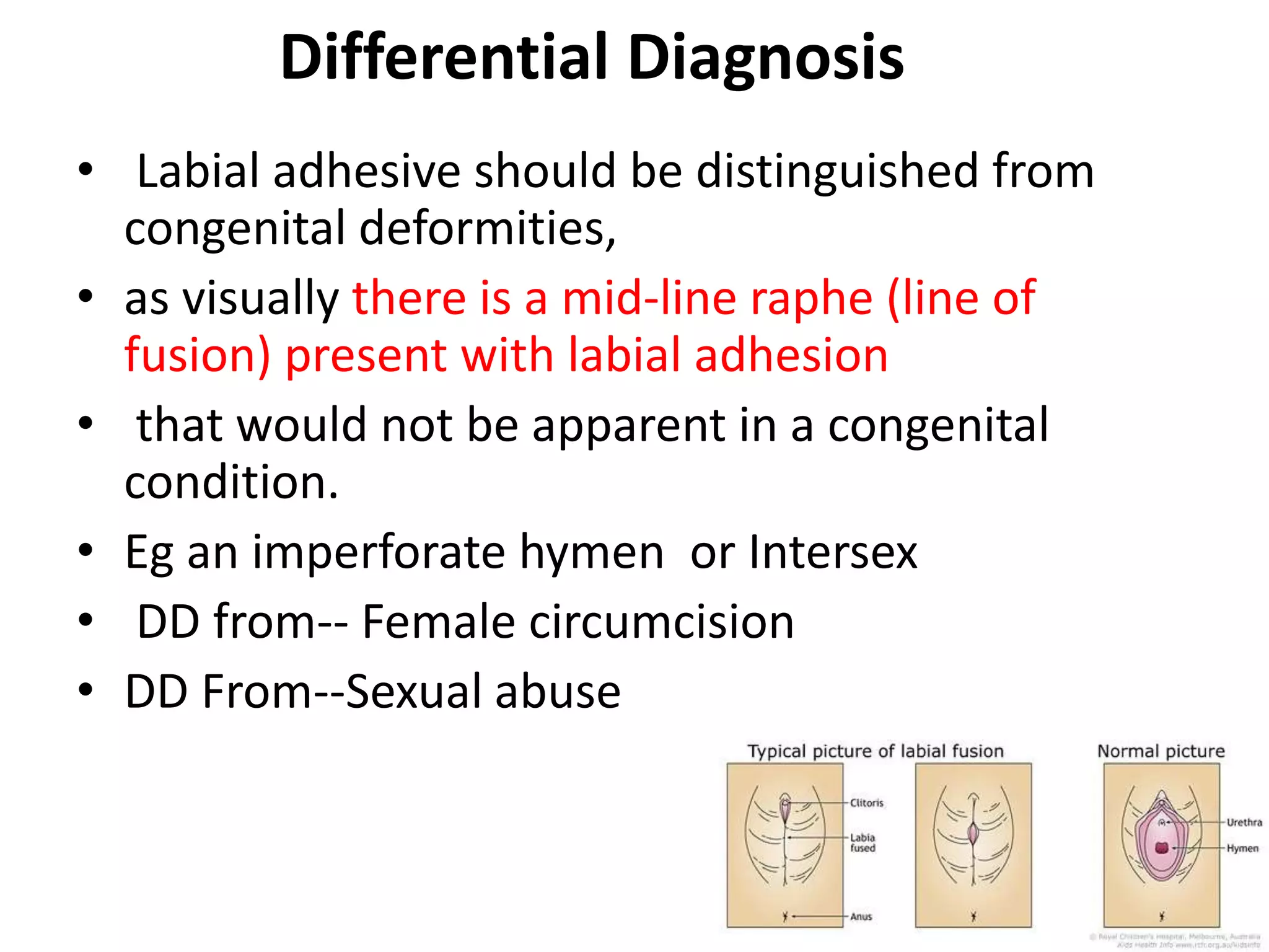Differential Diagnosis
• Labial adhesive should be distinguished from
congenital deformities,
• as visually there is a mid-line raphe (line of
fusion) present with labial adhesion
• that would not be apparent in a congenital
condition.
• Eg an imperforate hymen or Intersex
• DD from-- Female circumcision
• DD From--Sexual abuse
 