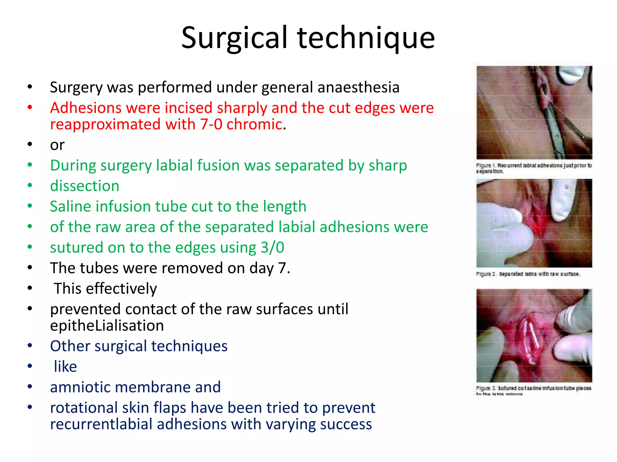 Surgical technique
• Surgery was performed under general anaesthesia
• Adhesions were incised sharply and the cut edges were
reapproximated with 7-0 chromic.
• or
• During surgery labial fusion was separated by sharp
• dissection
• Saline infusion tube cut to the length
• of the raw area of the separated labial adhesions were
• sutured on to the edges using 3/0
• The tubes were removed on day 7.
• This effectively
• prevented contact of the raw surfaces until
epitheLialisation
• Other surgical techniques
• like
• amniotic membrane and
• rotational skin flaps have been tried to prevent
recurrentlabial adhesions with varying success
 