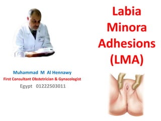 Labia
Minora
Adhesions
(LMA)
Muhammad M Al Hennawy
First Consultant Obstetrician & Gynacologist
Egypt 01222503011
 