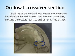 Occlusal crossover section
Distal leg of the vertical loop enters the embrasure
between canine and premolar or between premolars,
crossing the occlusal surface and entering into acrylic
 