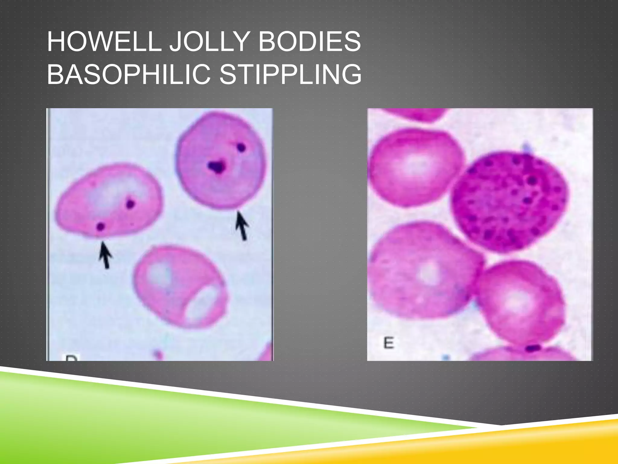 Howell Body Lab investigations of megaloblastic anaemia | PPTX