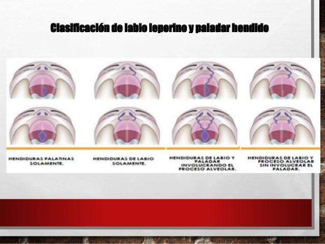 Labio leporino-y-paladar-hendido