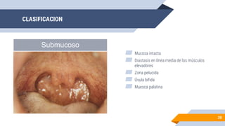 CLASIFICACION
20
Submucoso
▰ Mucosa intacta
▰ Diastasis en línea media de los músculos
elevadores
▰ Zona pelucida
▰ Úvula bífida
▰ Muesca palatina
 