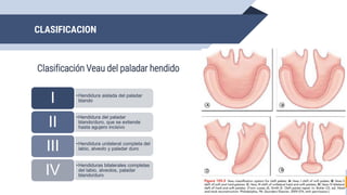 CLASIFICACION
Clasificación Veau del paladar hendido
21
•Hendidura aislada del paladar
blando
I
•Hendidura del paladar
blando/duro, que se extiende
hasta agujero incisivo
II
•Hendidura unilateral completa del
labio, alveolo y paladar duro
III
•Hendiduras bilaterales completas
del labio, alveolos, paladar
blando/duro
IV
 