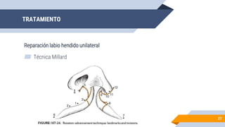 TRATAMIENTO
Reparación labio hendido unilateral
27
▰ Técnica Millard
 