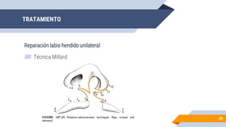 TRATAMIENTO
Reparación labio hendido unilateral
28
▰ Técnica Millard
 