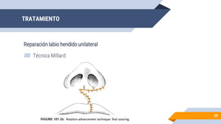 TRATAMIENTO
Reparación labio hendido unilateral
29
▰ Técnica Millard
 