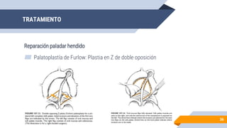 ▰ Palatoplastía de Furlow: Plastia en Z de doble oposición
TRATAMIENTO
36
Reparación paladar hendido
 