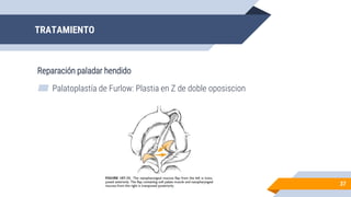 ▰ Palatoplastía de Furlow: Plastia en Z de doble oposiscion
TRATAMIENTO
37
Reparación paladar hendido
 