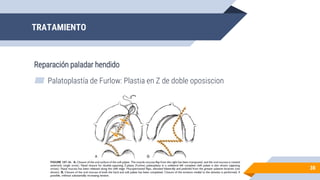 ▰ Palatoplastía de Furlow: Plastia en Z de doble oposiscion
TRATAMIENTO
38
Reparación paladar hendido
 