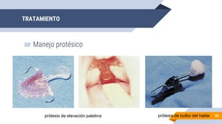 TRATAMIENTO
▰ Manejo protésico
52
prótesis de elevación palatina prótesis de bulbo del habla
 