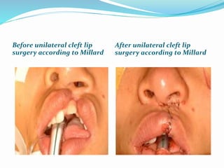 Before unilateral cleft lip
surgery according to Millard
After unilateral cleft lip
surgery according to Millard
 