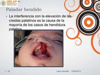 Paladar hendido
 La interferencia con la elevación de las
crestas palatinos es la causa de la
mayoría de los casos de hendidura
palatina.
∞π
13/05/201320 Labio Hendido
 