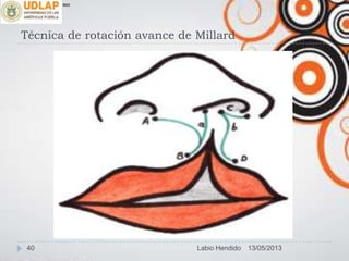 Técnica de rotación avance de Millard
∞π
13/05/201340 Labio Hendido
 