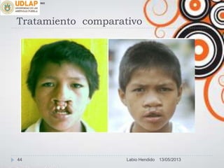 Tratamiento comparativo
∞π
13/05/201344 Labio Hendido
 