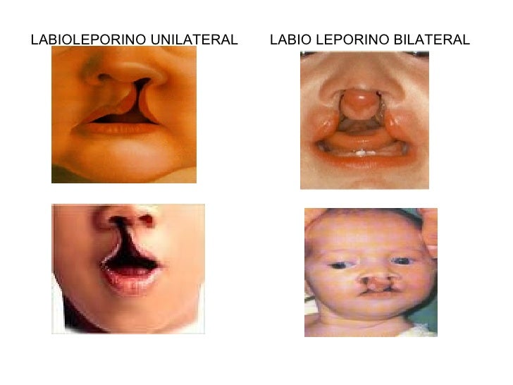 bilateral cleft lip