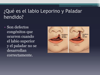 Labio leporino y paladar hendido | PPTX