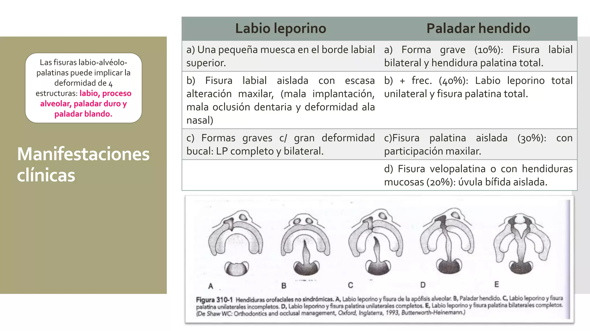 Labio leporino y paladar hendido en pediatría | PPTX
