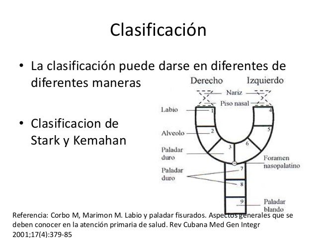 Labio paladar hendido