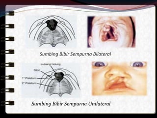 Sumbing Bibir Sempurna Bilateral
Sumbing Bibir Sempurna Unilateral
 