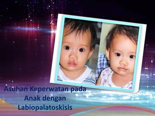Asuhan Keperwatan pada
Anak dengan
Labiopalatoskisis
 