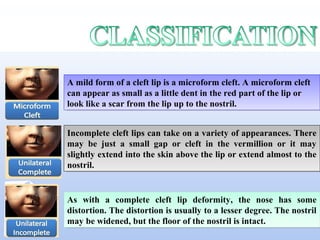 As with a complete cleft lip deformity, the nose has some
distortion. The distortion is usually to a lesser degree. The nostril
may be widened, but the floor of the nostril is intact.
As with a complete cleft lip deformity, the nose has some
distortion. The distortion is usually to a lesser degree. The nostril
may be widened, but the floor of the nostril is intact.
Incomplete cleft lips can take on a variety of appearances. There
may be just a small gap or cleft in the vermillion or it may
slightly extend into the skin above the lip or extend almost to the
nostril.
Incomplete cleft lips can take on a variety of appearances. There
may be just a small gap or cleft in the vermillion or it may
slightly extend into the skin above the lip or extend almost to the
nostril.
A mild form of a cleft lip is a microform cleft. A microform cleft
can appear as small as a little dent in the red part of the lip or
look like a scar from the lip up to the nostril.
A mild form of a cleft lip is a microform cleft. A microform cleft
can appear as small as a little dent in the red part of the lip or
look like a scar from the lip up to the nostril.
 
