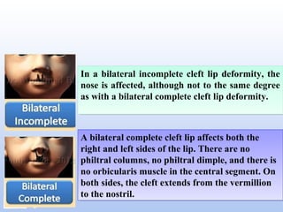 In a bilateral incomplete cleft lip deformity, the
nose is affected, although not to the same degree
as with a bilateral complete cleft lip deformity.
In a bilateral incomplete cleft lip deformity, the
nose is affected, although not to the same degree
as with a bilateral complete cleft lip deformity.
A bilateral complete cleft lip affects both the
right and left sides of the lip. There are no
philtral columns, no philtral dimple, and there is
no orbicularis muscle in the central segment. On
both sides, the cleft extends from the vermillion
to the nostril.
A bilateral complete cleft lip affects both the
right and left sides of the lip. There are no
philtral columns, no philtral dimple, and there is
no orbicularis muscle in the central segment. On
both sides, the cleft extends from the vermillion
to the nostril.
 