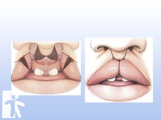 Labioplasty jumat ilmiah