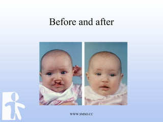 WWW.SMSO.CC
Before and after
 