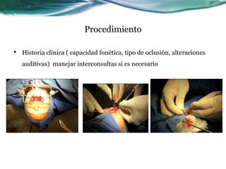 Procedimiento
• Historia clínica ( capacidad fonética, tipo de oclusión, alteraciones
auditivas) manejar interconsultas si es necesario
 
