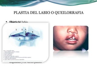 PLASTIA DEL LABIO O QUEILORRAFIA
• Fisura del labio
• Defecto de narina
• Puede haber ausencia de piso
de nariz
• Deformidad del ala nasal y
tabique nasal
• Premaxila y prolabio
desviados
• Objetivos
• Lograr labio simétrico y bien
contorneado
• Funcional
• Buena capa muscular
• Definición estructural en todo
el espesor
• Evitar la contracción cicatrizal
lineal
• Por eso se hacen las incisiones
anguladas y en varios planos
 