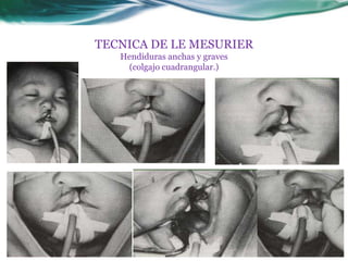 TECNICA DE LE MESURIER
Hendiduras anchas y graves
(colgajo cuadrangular.)
 