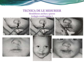 TECNICA DE LE MESURIER
Hendiduras anchas y graves
(colgajo cuadrangular.)
 