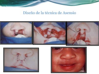 Diseño de la técnica de Asensio
 
