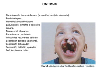 SINTOMAS
Cambios en la forma de la nariz (la cantidad de distorsión varia)
Perdida de peso.
Problemas de alimentación
Expulsión del alimento a través de
la nariz.
Dientes mal alineados.
Retardo en el crecimiento.
Infecciones recurrentes del oído.
Separación del labio solamente.
Separación del paladar.
Separación del labio y paladar.
Deficiencia en el habla.
 