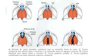 A. Normal. B. Labio hendido unilateral que se extiende hacia la nariz. C. Fisura
unilateral que afecta labio y maxilar y se extiende hacia el agujero incisivo. D. Fisura
bilateral que afecta labio y maxilar. E. Fisura palatina aislada. F. Fisura palatina
 