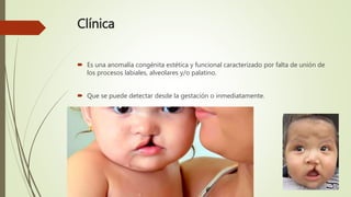 Clínica
 Es una anomalía congénita estética y funcional caracterizado por falta de unión de
los procesos labiales, alveolares y/o palatino.
 Que se puede detectar desde la gestación o inmediatamente.
 