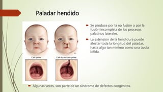 Paladar hendido
 Se produce por la no fusión o por la
fusión incompleta de los procesos
palatinos laterales.
 La extensión de la hendidura puede
afectar toda la longitud del paladar,
hasta algo tan mínimo como una úvula
bífida.
 Algunas veces, son parte de un síndrome de defectos congénitos.
 