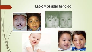 Labio y paladar hendido
 