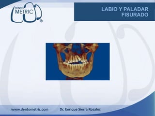 www.dentometric.com Dr. Enrique Sierra Rosales
LABIO Y PALADAR
FISURADO
 