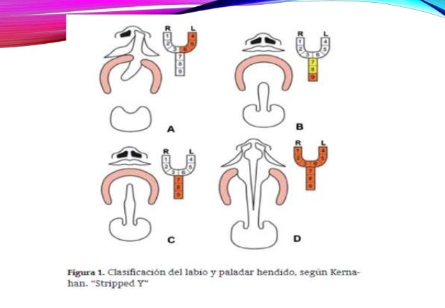 Labio y paladar hendido