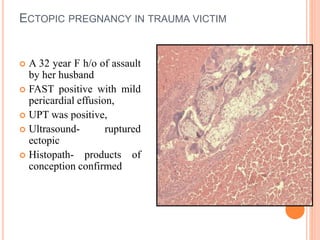 ECTOPIC PREGNANCY IN TRAUMA VICTIM
 A 32 year F h/o of assault
by her husband
 FAST positive with mild
pericardial effus...