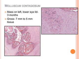MOLLUSCUM CONTAGIOSUM
 Mass on left, lower eye lid-
3 months
 Gross- 7 mm to 5 mm
tissue
 