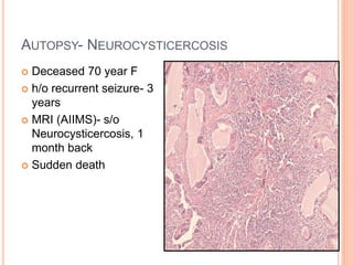 AUTOPSY- NEUROCYSTICERCOSIS
 Deceased 70 year F
 h/o recurrent seizure- 3
years
 MRI (AIIMS)- s/o
Neurocysticercosis, 1...