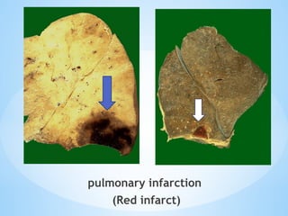 Lab No.8 Infarction and Embolism 2025.pptx